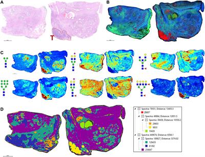 Direct N-Glycosylation Profiling of Urine and Prostatic Fluid Glycoproteins and Extracellular Vesicles